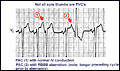 ecg_403.gif